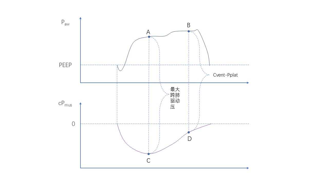 Pmus监测--呼吸支持决策新“视”角